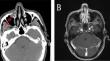 A case of high-grade non-intestinal paranasal sinus adenocarcinoma primary in the maxillary sinus: targeted therapy after postoperative immunocombination with chemotherapy.