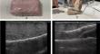 Comparison of state-of-the-art biopsy systems for ultrasound-guided breast biopsy using a chicken breast phantom.