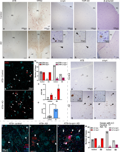 Tau pathology in the dorsal raphe may be a prodromal indicator of Alzheimer’s disease