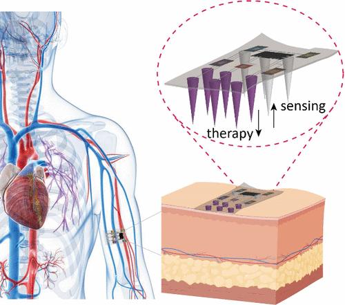Microneedles-Based Theranostic Platform: From the Past to the Future.