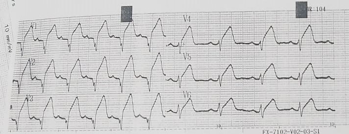 Left ventricle pedunculated thrombi risks and outcomes: a case report and literature review.