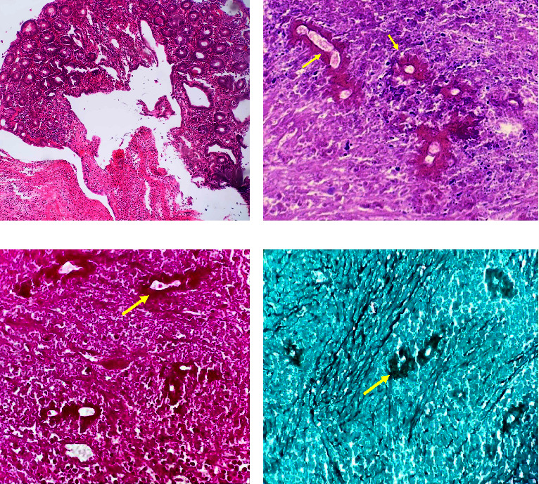 Disseminated Gastrointestinal Basidiobolomycosis: A Case Report with Review of Diagnostic Clues.