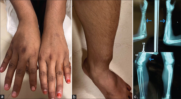 Hereditary Multiple Exostoses with Rare Ocular Finding: A Case Report.