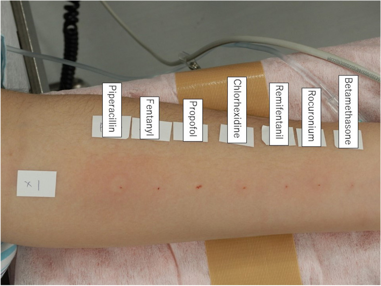 Causative agent for perioperative anaphylaxis in a child with autism successfully identified using the intradermal test under general anesthesia.
