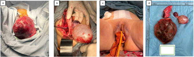 Diagnostics and Management Challenges of Nonpuerperal Uterine Inversions - Case Series.