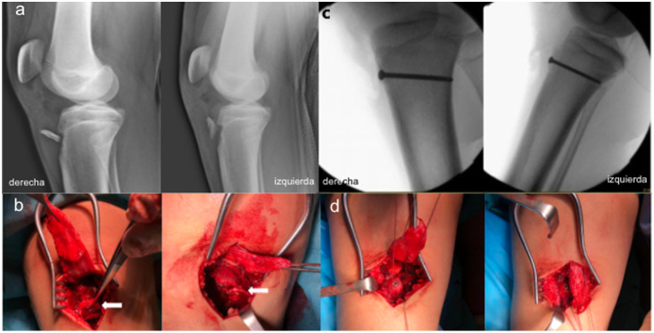 Bilateral fracture of anterior tibial tuberosity with complete patellar tendon rupture in an adolescent patient.