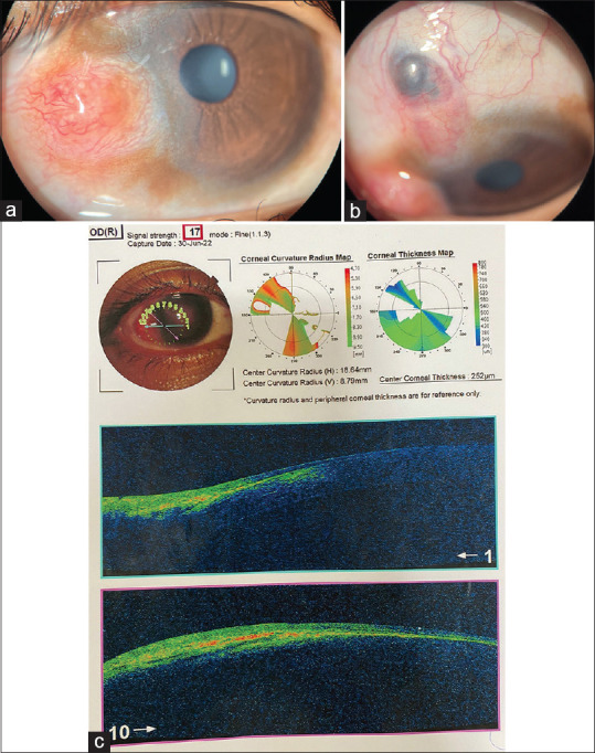 Hereditary Multiple Exostoses with Rare Ocular Finding: A Case Report.