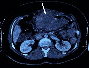 Disseminated Gastrointestinal Basidiobolomycosis: A Case Report with Review of Diagnostic Clues.