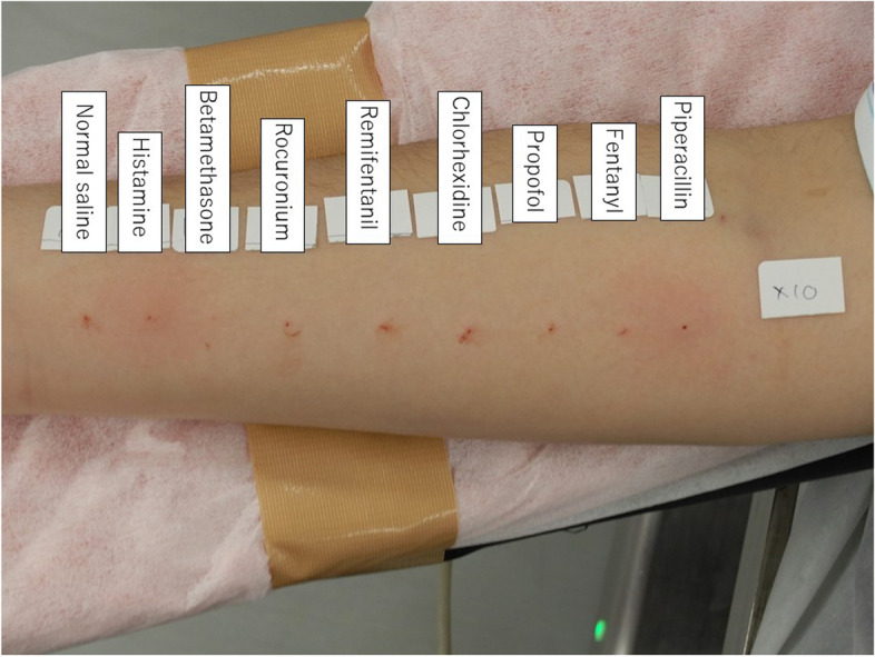Causative agent for perioperative anaphylaxis in a child with autism successfully identified using the intradermal test under general anesthesia.
