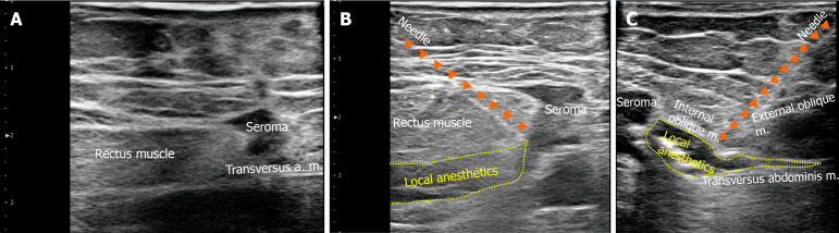 Ultrasound-guided peripheral nerve blocks for anterior cutaneous nerve entrapment syndrome after robot-assisted gastrectomy: A case report.