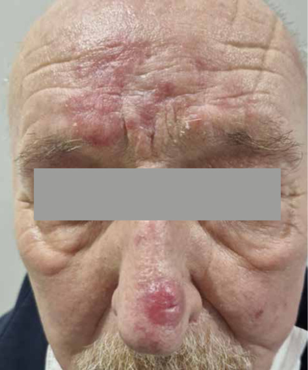 3D technique in superficial brachytherapy: New attitude in old field of mycosis fungoides.