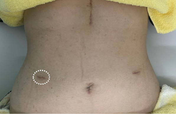 Ultrasound-guided peripheral nerve blocks for anterior cutaneous nerve entrapment syndrome after robot-assisted gastrectomy: A case report.