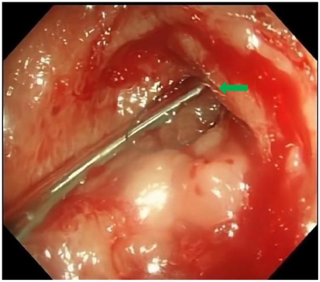Retrograde colon imaging through colonic transendoscopic enteral tubing helps to confirm the cause of difficult colonoscopy: a case report.