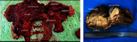 Disseminated Gastrointestinal Basidiobolomycosis: A Case Report with Review of Diagnostic Clues.