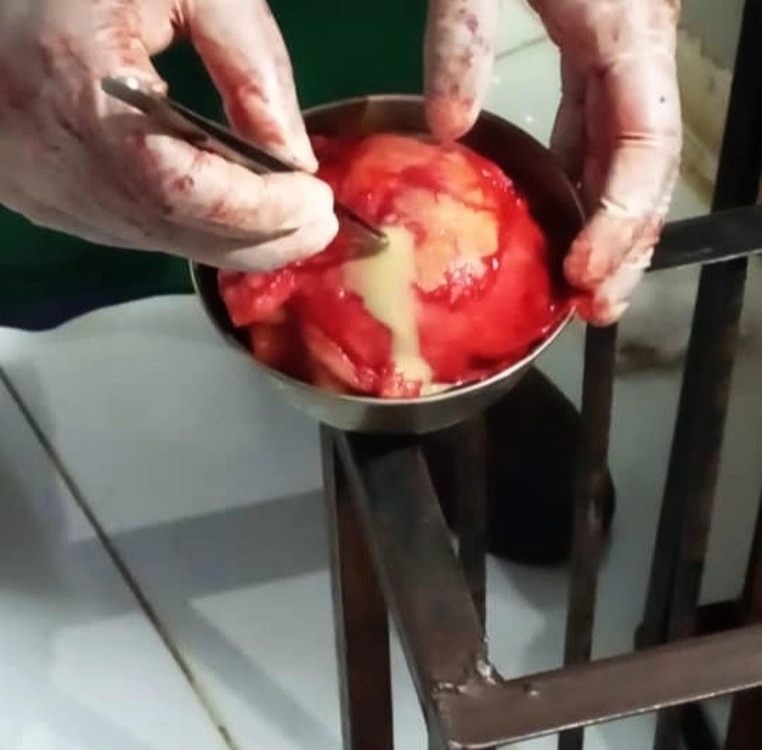 Unintentionally retained lap sponge mimicking an ovarian cyst two years after Caesarean section in a 37-year old patient: case report of a rare "never event" in Sudan.
