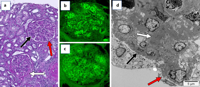 First Successful Treatment of a Patient with a Primary Immune Complex-Membranoproliferative Glomerulonephritis with Iptacopan: A Case Report.