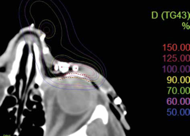 3D technique in superficial brachytherapy: New attitude in old field of mycosis fungoides.
