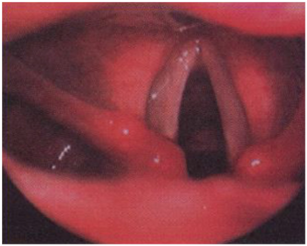 Recurrent nerve damage following thyroid surgery: What can I do?