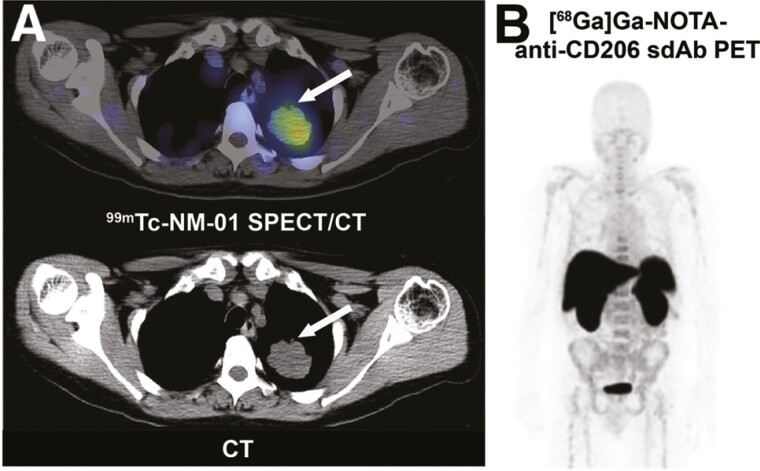 Advancements in nuclear imaging using radiolabeled nanobody tracers to support cancer immunotherapy.