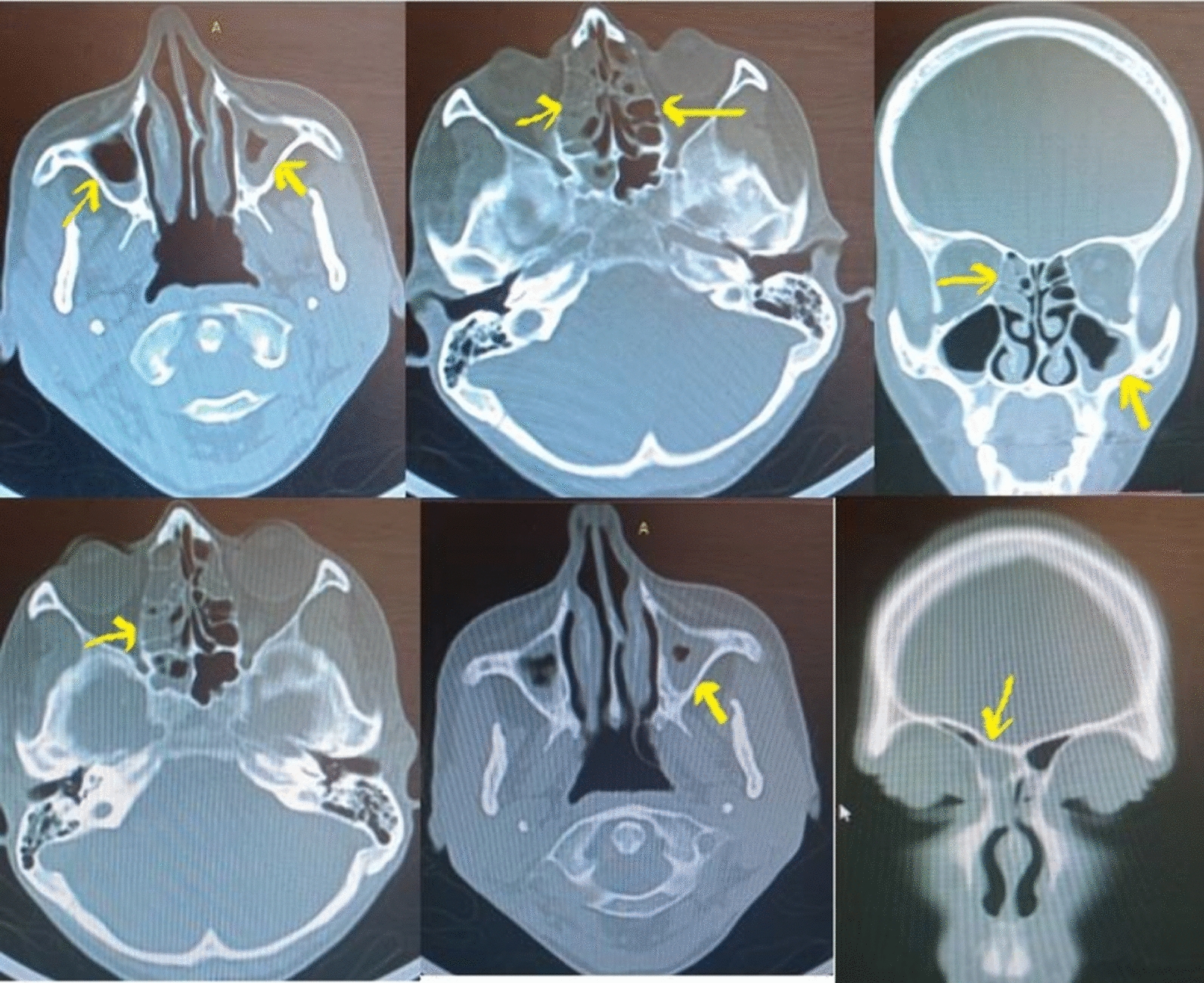 Bronchiectasis combined with chronic sinusitis following Celiac disease: a case report.