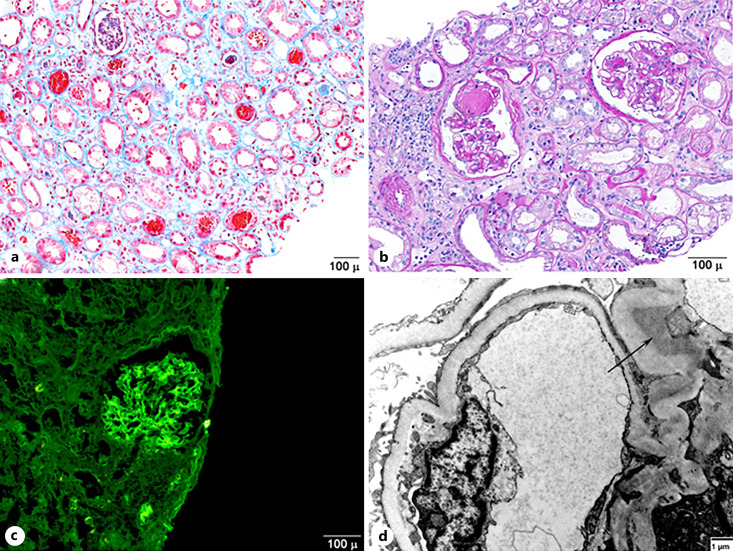 An Overlap of Anticoagulant-Related and IgA Nephropathy: A Case Report.