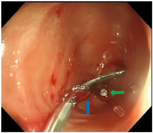 Retrograde colon imaging through colonic transendoscopic enteral tubing helps to confirm the cause of difficult colonoscopy: a case report.