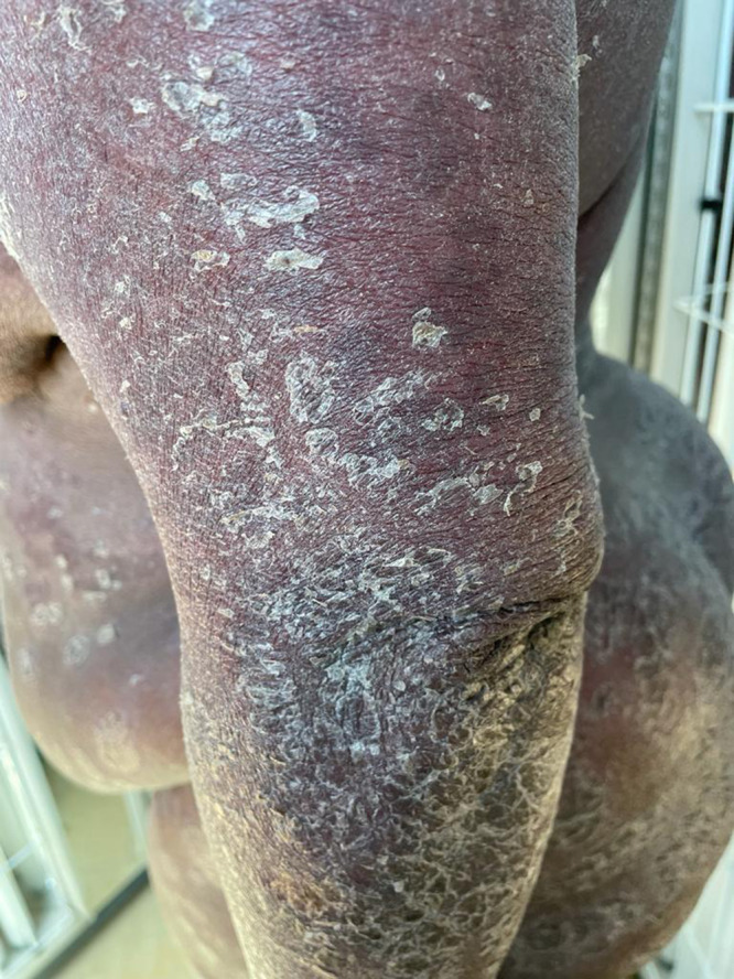 Adapting the Goeckerman Regimen for Psoriasis Treatment in Kenya: A Case Study of Successful Management in a Resource-Limited Setting.