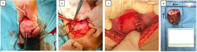 Diagnostics and Management Challenges of Nonpuerperal Uterine Inversions - Case Series.