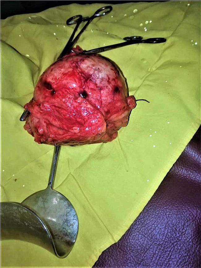 Unintentionally retained lap sponge mimicking an ovarian cyst two years after Caesarean section in a 37-year old patient: case report of a rare "never event" in Sudan.