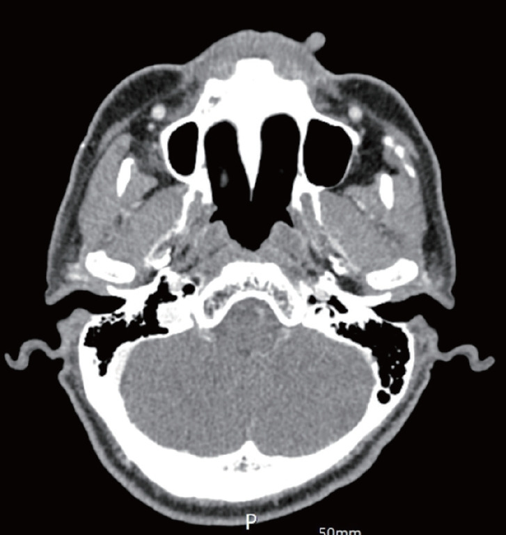An unusual exophytic pleomorphic adenoma on the upper lip skin without mucosa involvement: a case report.