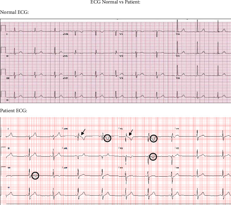 Swift Onset, Swift Recovery: Unusual Nonrheumatic Myocarditis in a Young Adult Post Group A Streptococcal Pharyngitis.