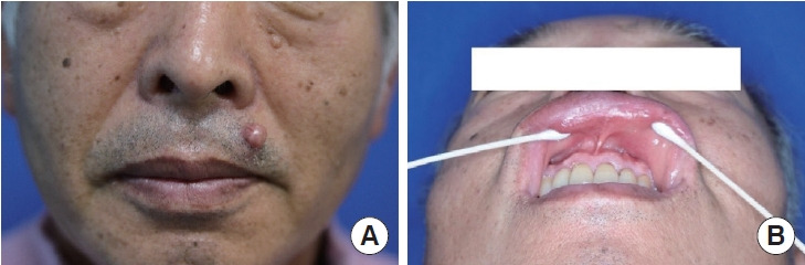 An unusual exophytic pleomorphic adenoma on the upper lip skin without mucosa involvement: a case report.