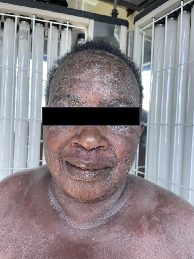 Adapting the Goeckerman Regimen for Psoriasis Treatment in Kenya: A Case Study of Successful Management in a Resource-Limited Setting.