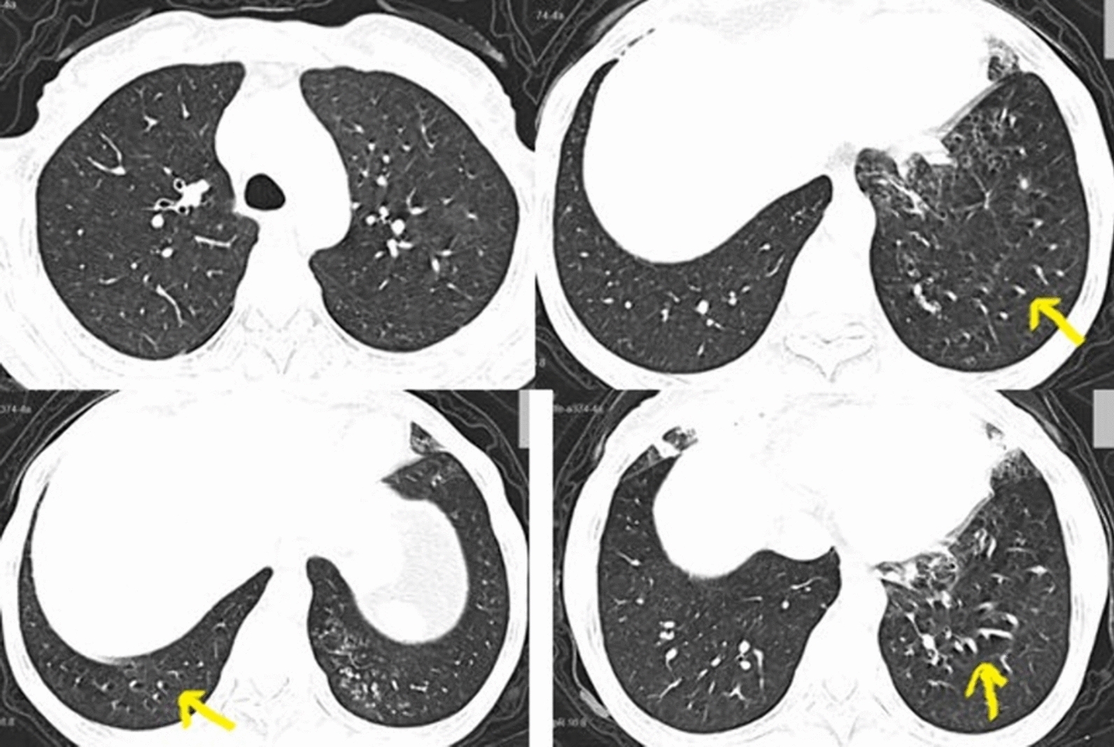Bronchiectasis combined with chronic sinusitis following Celiac disease: a case report.