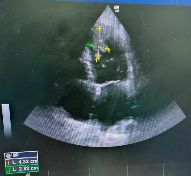 Left ventricle pedunculated thrombi risks and outcomes: a case report and literature review.