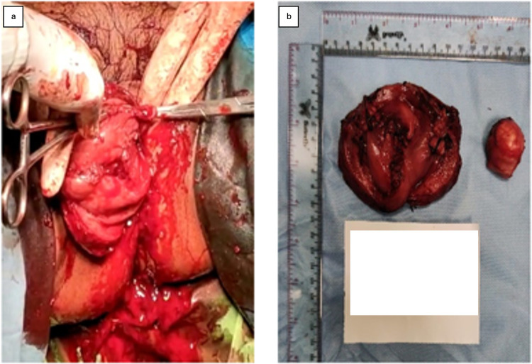 Diagnostics and Management Challenges of Nonpuerperal Uterine Inversions - Case Series.