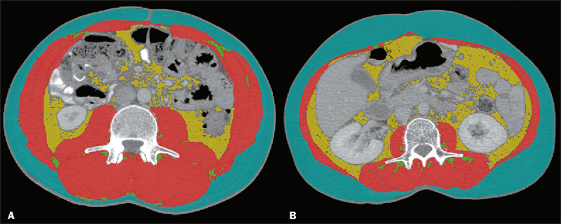 The additional benefit of computed tomography in cancer patients: impacts of sarcopenia and cachexia on quality of life during chemotherapy.