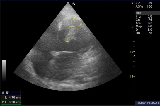 Left ventricle pedunculated thrombi risks and outcomes: a case report and literature review.