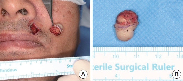 An unusual exophytic pleomorphic adenoma on the upper lip skin without mucosa involvement: a case report.