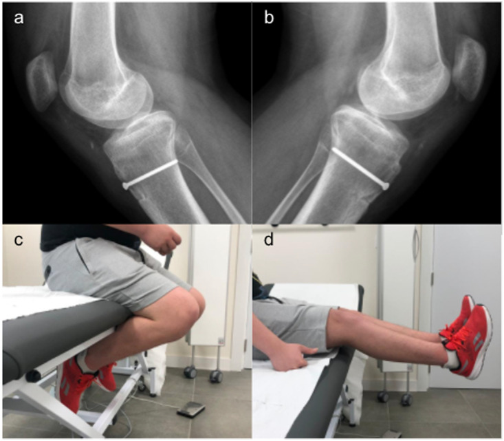 Bilateral fracture of anterior tibial tuberosity with complete patellar tendon rupture in an adolescent patient.