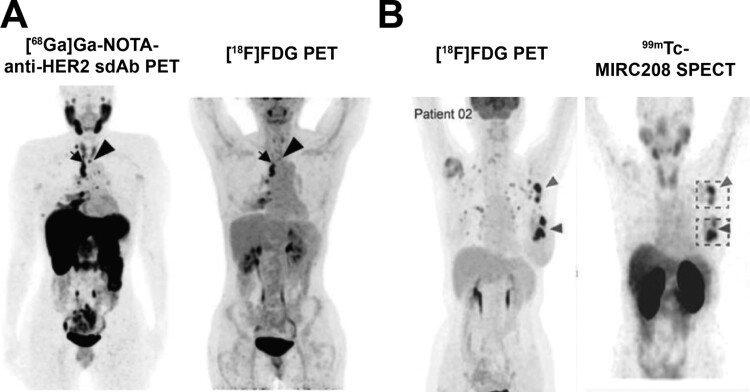 Advancements in nuclear imaging using radiolabeled nanobody tracers to support cancer immunotherapy.