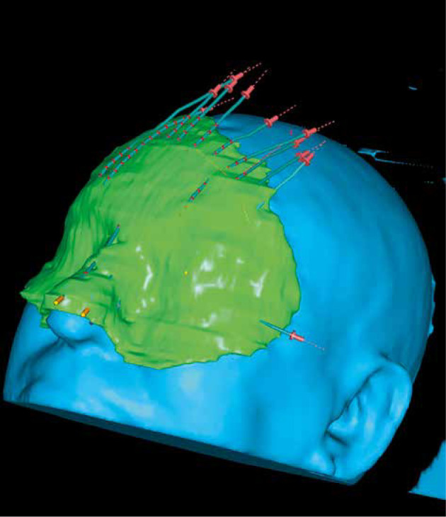 3D technique in superficial brachytherapy: New attitude in old field of mycosis fungoides.