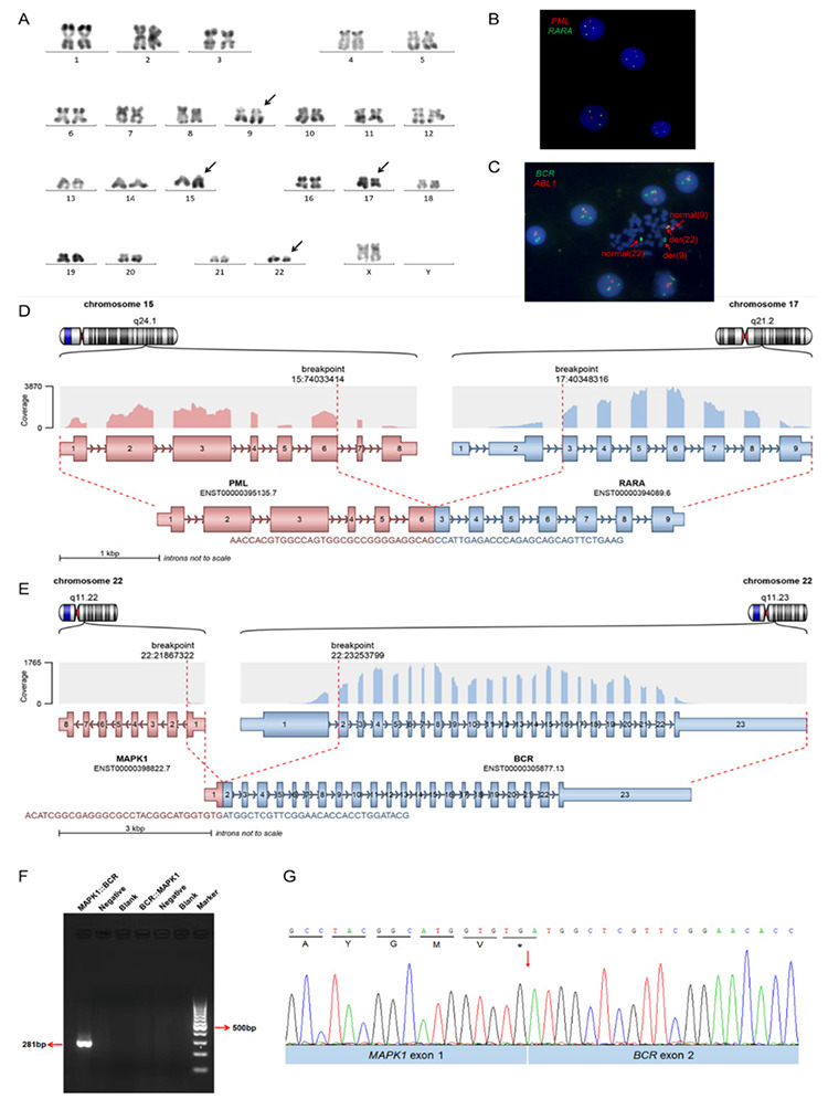 Identification of a Novel <i>MAPK1::BCR</i> Fusion Gene/t(9;22) (q34;q11) in a Case of Acute Promyelocytic Leukemia
