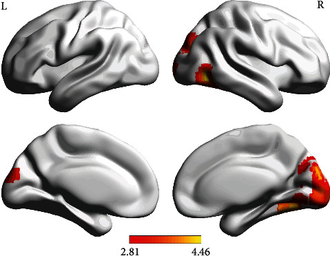 Modulation of High-Frequency rTMS on Reward Circuitry in Individuals with Nicotine Dependence: A Preliminary fMRI Study.