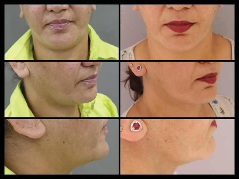 Ultrasound-Assisted Chin Liposuction under Local Anesthesia: An Effective Tool for Facial Slimming in Indian Population.