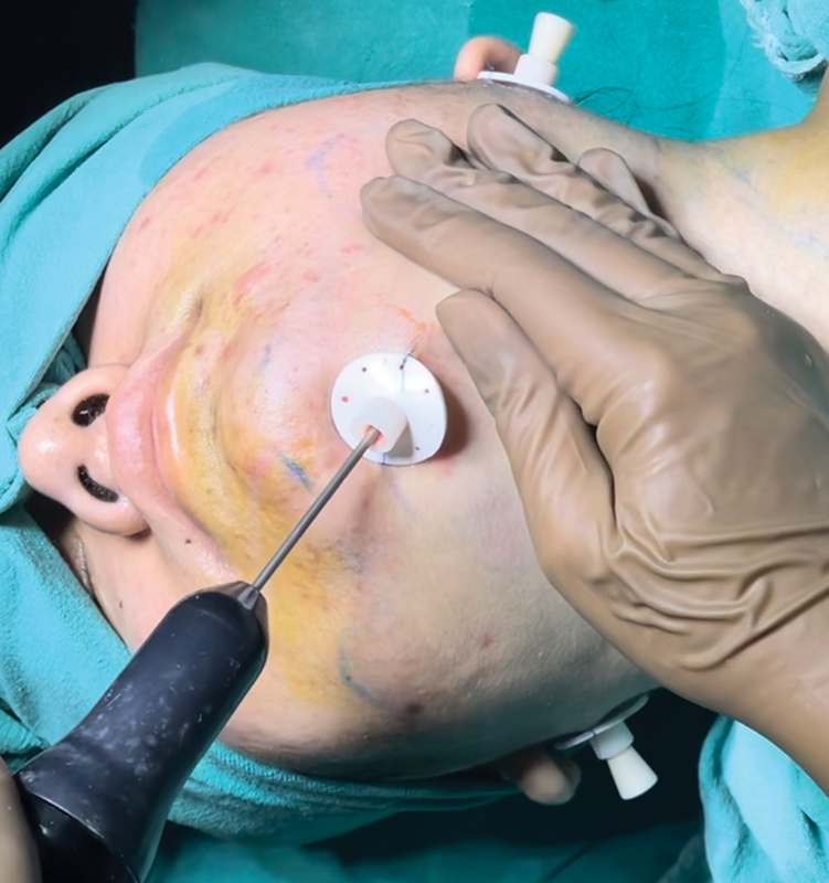 Ultrasound-Assisted Chin Liposuction under Local Anesthesia: An Effective Tool for Facial Slimming in Indian Population.