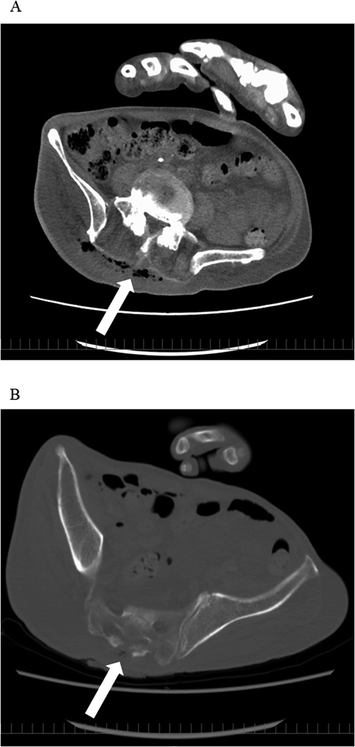 Decubitus ulcer infection and bacteremia due to tazobactam/piperacillin-resistant <i>Veillonella parvula</i>.