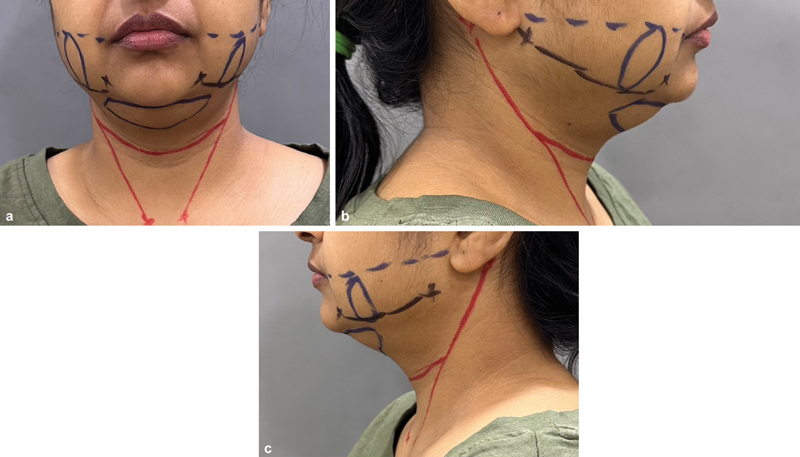 Ultrasound-Assisted Chin Liposuction under Local Anesthesia: An Effective Tool for Facial Slimming in Indian Population.