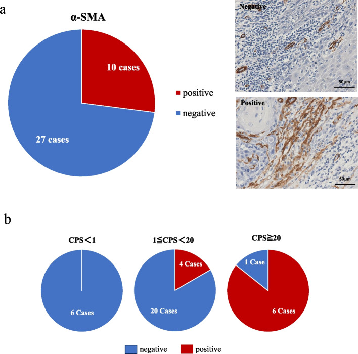 Pathological examination of factors involved in PD-L1 expression in patients with oral tongue squamous cell carcinoma.