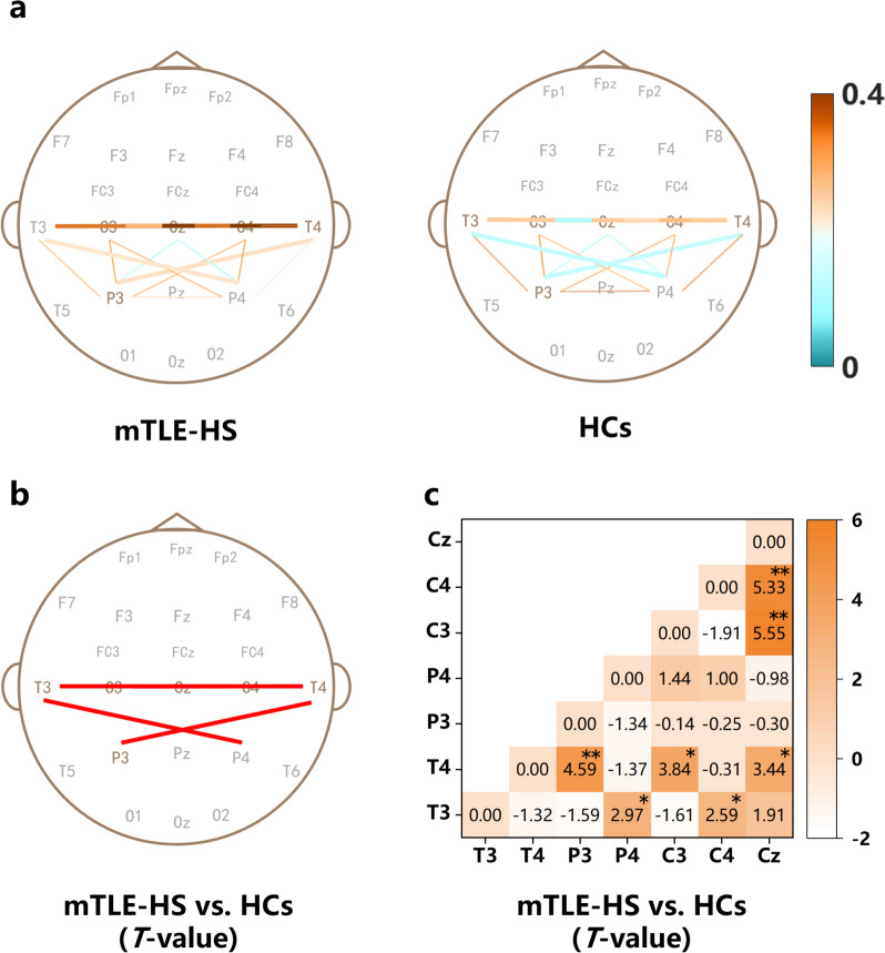 Differences and potential mechanisms of theta oscillation and temporoparietal and temporal-central networks in temporal lobe epilepsy patients with unilateral hippocampal sclerosis.
